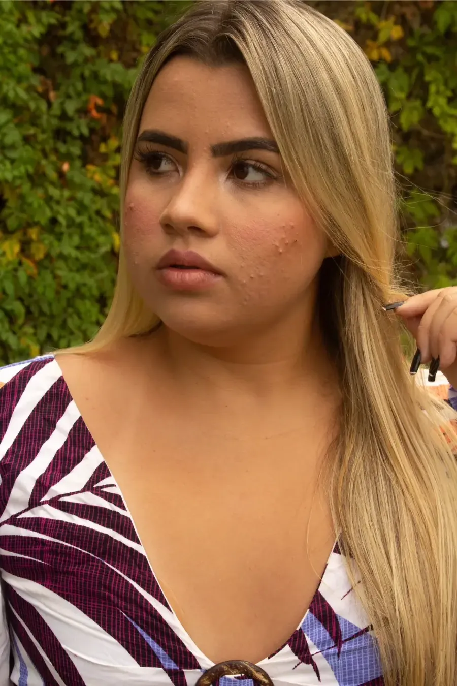 Antes: rosto com espinhas e manchas